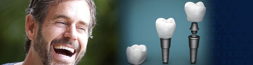 permanent teeth implants in India
