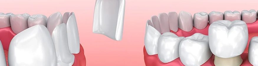Porcelain Veneers vs. Dental Crowns: What's Right for You?