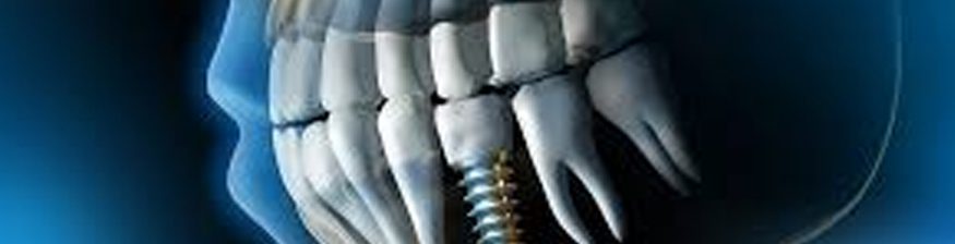 Dental Implants & Autoimmune Diseases