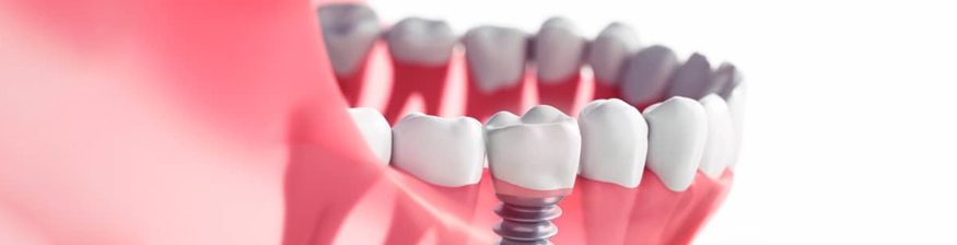 How Dental Implants Can Enhance Your Facial Structure