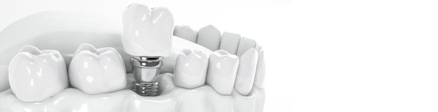 Dental Implants May Be the Key to Long-Term Digestive Health